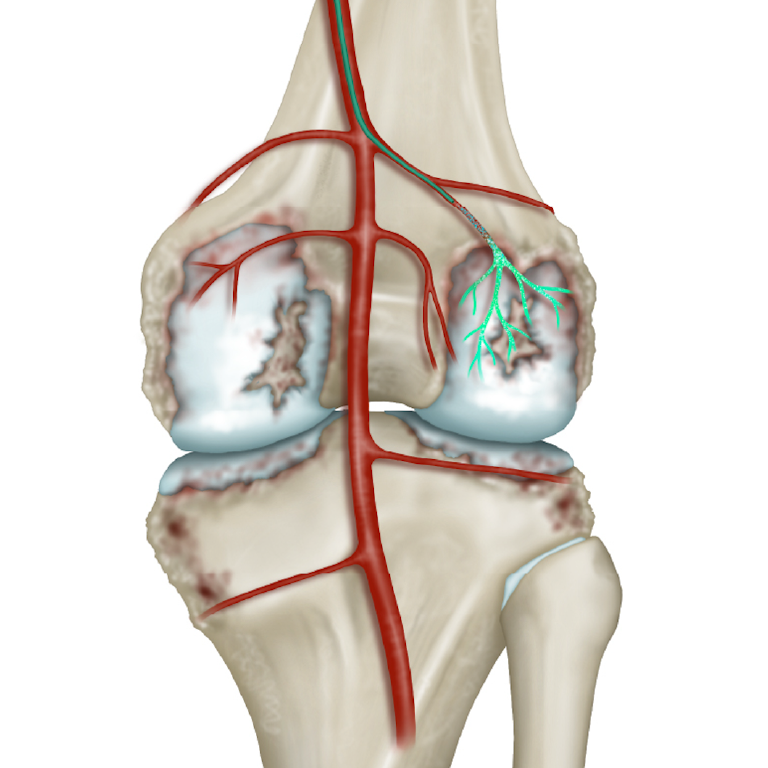 Knee Pain