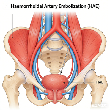 Haemorrhoidal Artery Embolization (HAE)